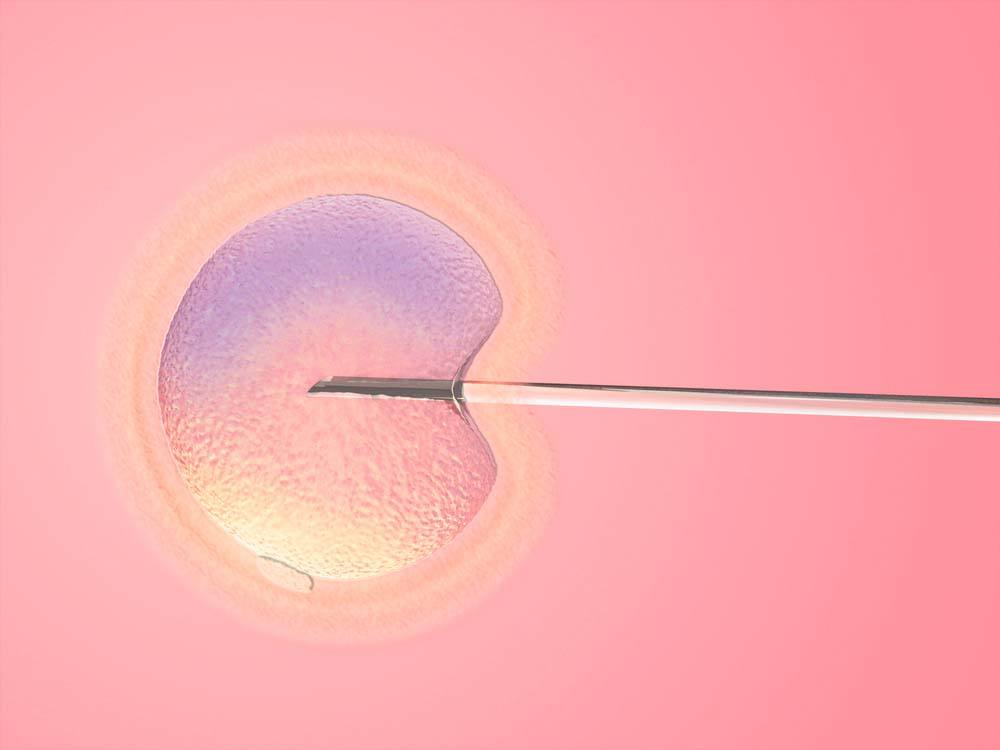 精子洗涤+ICSI单精子注射