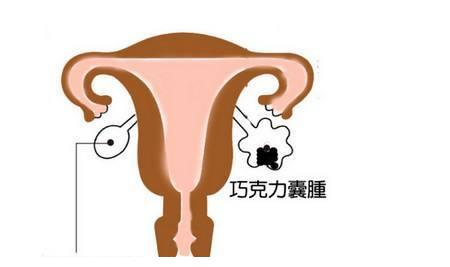 子宫内膜异位会导致输卵管粘连，让卵子和精子无法结合形成受精卵
